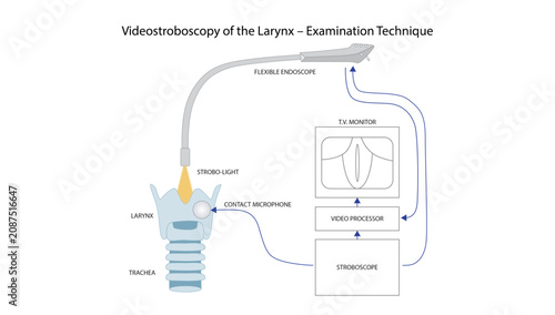 Tableau sur toile Videostroboscopy of the Larynx – Examination Technique, Medical illustration dem