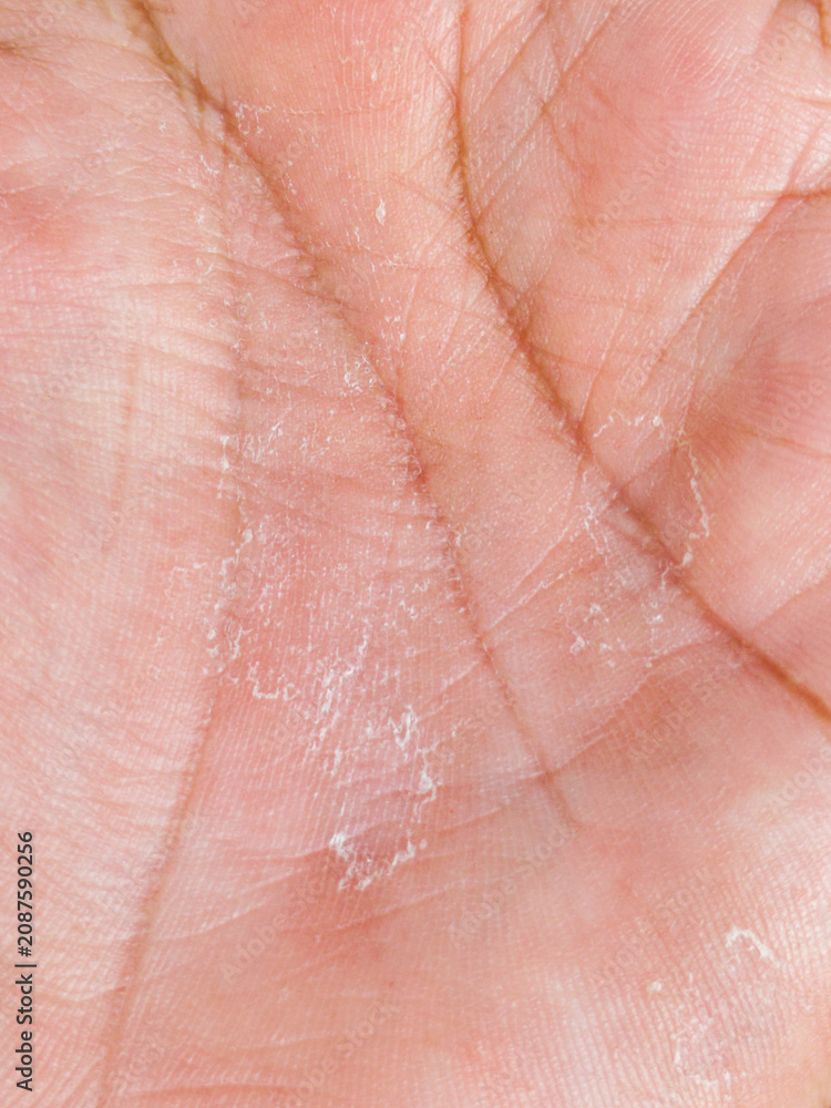 Fototapeta premium Closeup of dry human palm skin with peeling texture and visible lines, highlighting dehydration, skincare, dermatology, and natural skin detail.