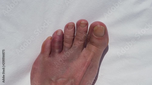 Bruised and swollen toe after hitting a rock, concept of foot injury, pain, trauma, healthcare and recovery.