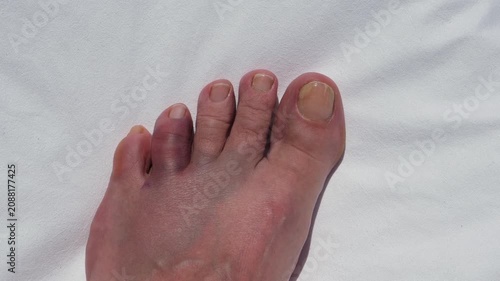 Bruised and swollen toe after hitting a rock, concept of foot injury, pain, trauma, healthcare and recovery.