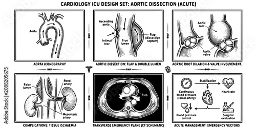 Foto Aortic Dissection Engraving Black White-Root Dilation Flap Ischaemia Plane-Emerg