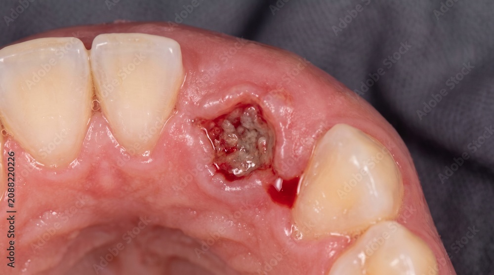 Fototapeta premium Oral cancer gum lesion close up macro photograph showing ulcerative lower gum tissue breakdown irregular borders adjacent teeth and wet mucosal texture