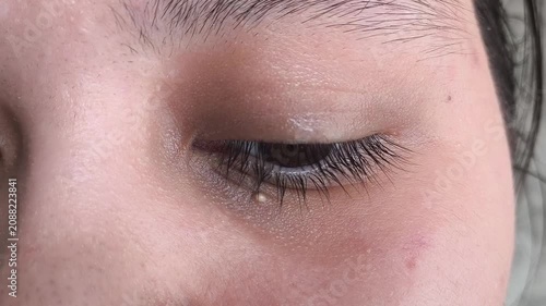 milia on facial skin near eye, skincare routine, dermatology and cosmetic treatment concept.