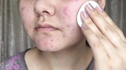 Close up of woman wiping face with cotton pad, removing excess oil, skincare, healthy skin and personal care concept.