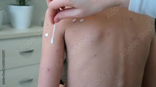 Mother applies chickenpox remedy on hand of her daughter. Chickenpox treatment at home. 7 years old child with chickenpox. Mom lubricates rash from chickenpox with antiseptic using cotton bud.