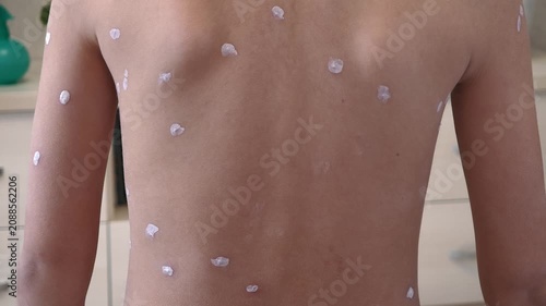 Back of child with chickenpox rash. Chickenpox treatment at home. 7 years old child with rash from chickenpox and with antiseptic on skin. Child suffers from chickenpox.