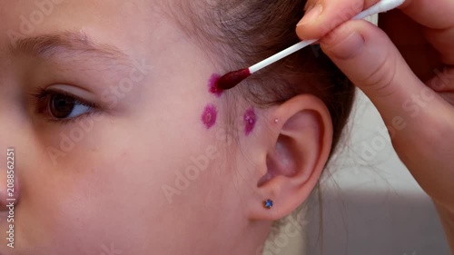 Mother applies chickenpox remedy on head of her daughter. Chickenpox treatment at home. 7 years old child with chickenpox. Mom lubricates rash from chickenpox with antiseptic using cotton bud.