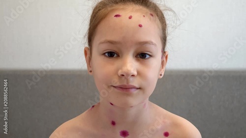Portrait of girl with chickenpox on her face. Beautiful toddler girl is looking at camera and smiling. Chickenpox treatment at home. Girl with rash from chickenpox and with antiseptic on skin.