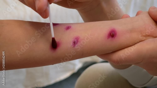 Mother applies chickenpox remedy on hand of her child. Chickenpox treatment at home. 7 years old child with chickenpox. Mom lubricates rash from chickenpox with antiseptic using cotton bud.