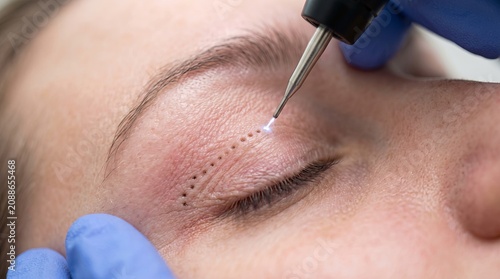 plasma pen treatment on upper eyelid during non surgical blepharoplasty macro close up