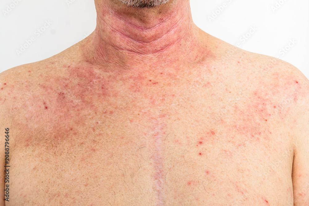 Naklejka premium Adult man's neck and chest showing red atopic dermatitis rash patches, dermatology medical photography, skin condition close-up, eczema awareness.