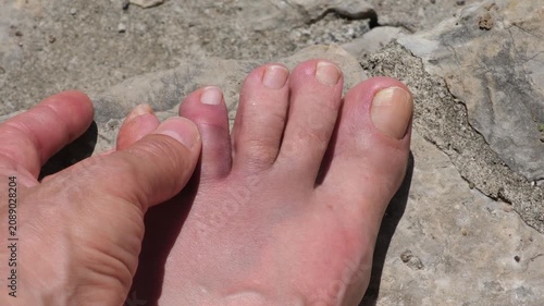 A swollen and bruised toe after accidentally hitting a rock on a beach vacation. Foot injury concept, accident, first aid, healthcare, and recovery.
