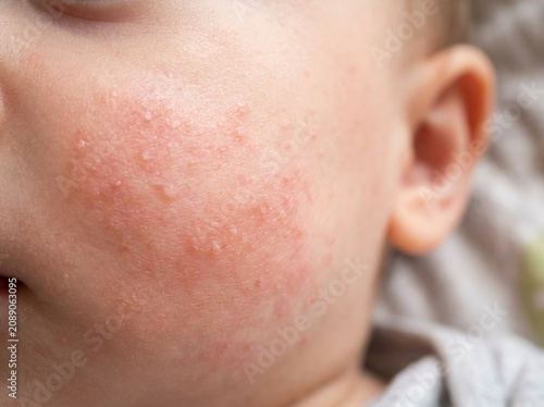 Принти на полотні Close-up of baby's red, irritated cheek with eczema rash and bumps, indicating sensitive skin or an allergic reaction, concept of infant skin conditions and pediatric dermatology