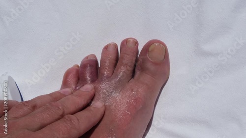 Applying pain relief ointment to an injured swollen toe after hitting a rock during a seaside vacation, concept of first aid, healthcare and recovery.