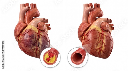 Unhealthy Human Heart with Acute Myocardial Infarction Isolated on White Background