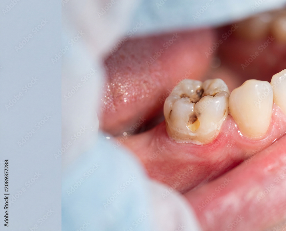 Fototapeta premium Moderate Tooth Decay on Human Molar Close Up of a human molar affected by moderate dental caries, illustrating early dentin exposure and natural enamel damage for oral healthcare education.