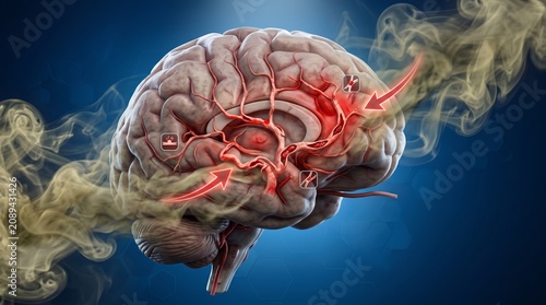 Healthcare concept showing smoking increasing the risk of stroke and brain damage