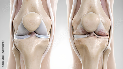 Knee osteoarthritis comparison medical illustration showing normal joint anatomy versus medial compartment cartilage wear with realistic bone detail for healthcare education patient information design