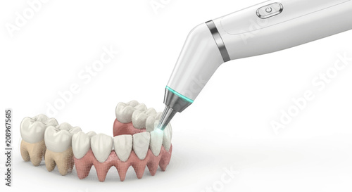 Advanced Dental Scaling Tool Cleaning Human Teeth Model for Professional Oral Hygiene and Periodontal Care Treatment