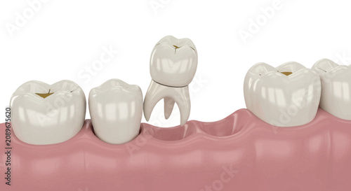 3D Render of a Dental Implant Crown Procedure Inserting into the Gum Line for Tooth Restoration Treatment Concept