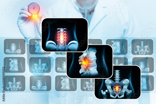 spinal column with implant, screw placement, 3d illustration