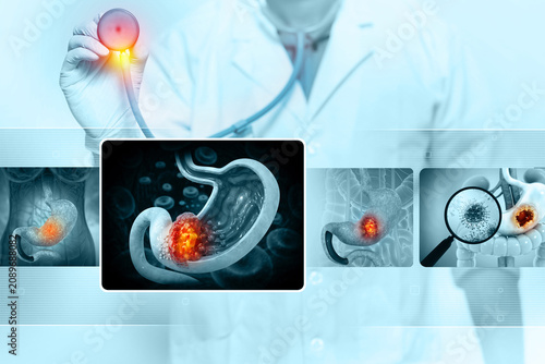 Cuadro en lienzo Gastric (stomach) cancer is a malignancy arising from the stomach lining, often caused by abnormal cell growth