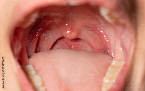 Фотография Sore throat with throat swollen
