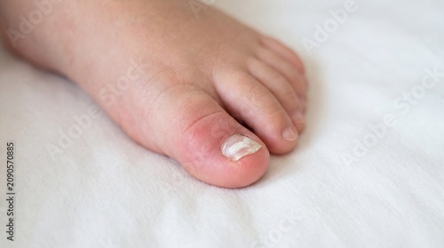 Close up of bare foot with ingrown toenail on white fabric surface