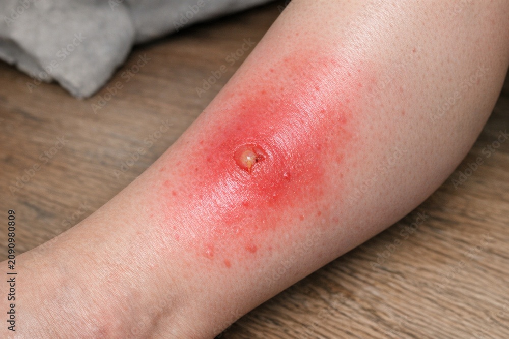 Fototapeta premium A person is shown with a wound on their leg