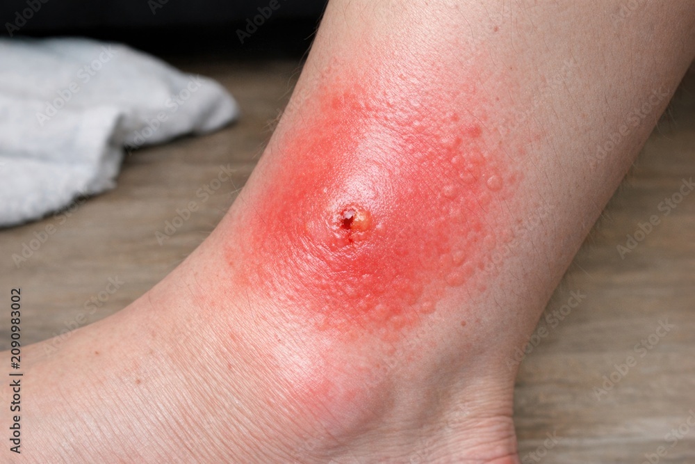 Fototapeta premium A close-up shot of a person's foot with a wound, suitable for medical or storytelling purposes