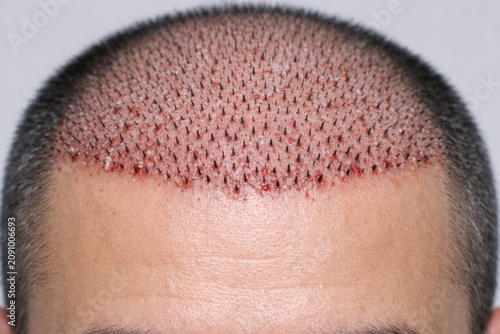 Post-surgery hair transplantation scalp close-up. Ai generative