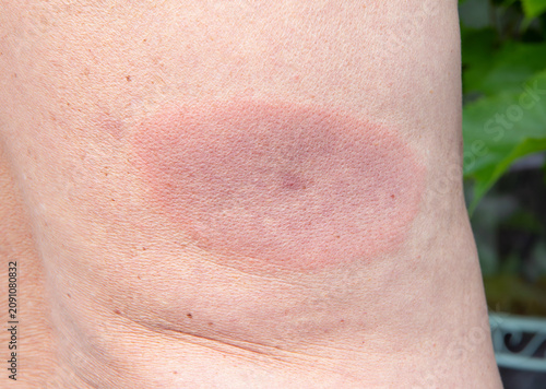 Lyme disease, also known as Lyme borreliosis, red rash patch on adult man back skin. Borreliosis is tick-borne disease. The rash was present for about a week before it was noticed and treatment.