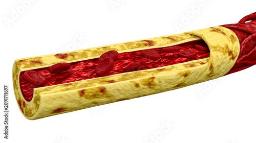 Schilderij op canvas Cross-section of a diseased artery with cholesterol plaque buildup and red blood