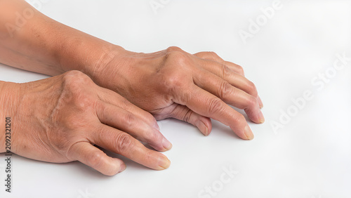 Rheumatoid arthritis hand joints with ulnar deviation, photorealistic medical education image of swollen fingers on white clinical background for patient education and healthcare communication
