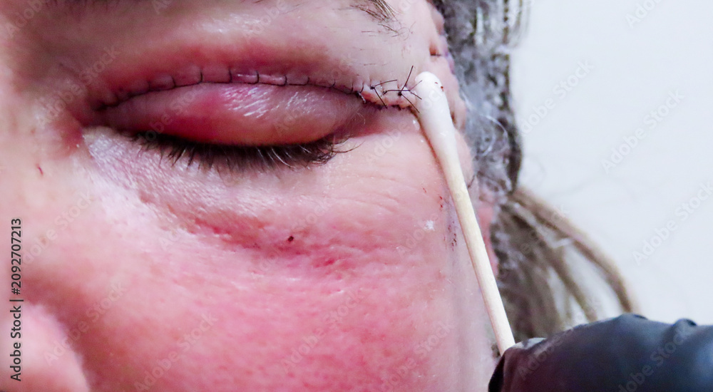 Fototapeta premium Close-up of a patient having sutures removed after facial and neck surgery during a postoperative follow-up appointment. Medical professional swabbing or removing stitches near the ear.