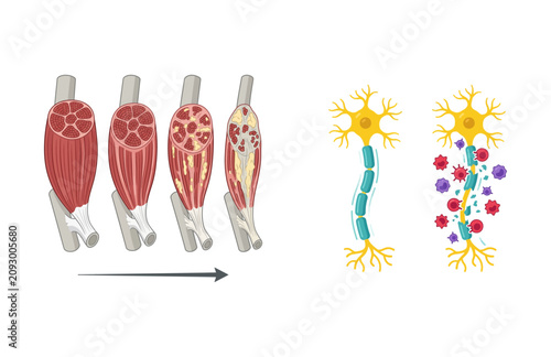 Konstfotografi Biological Progression of Muscle Degeneration and Nerve Cell Damage Illustration