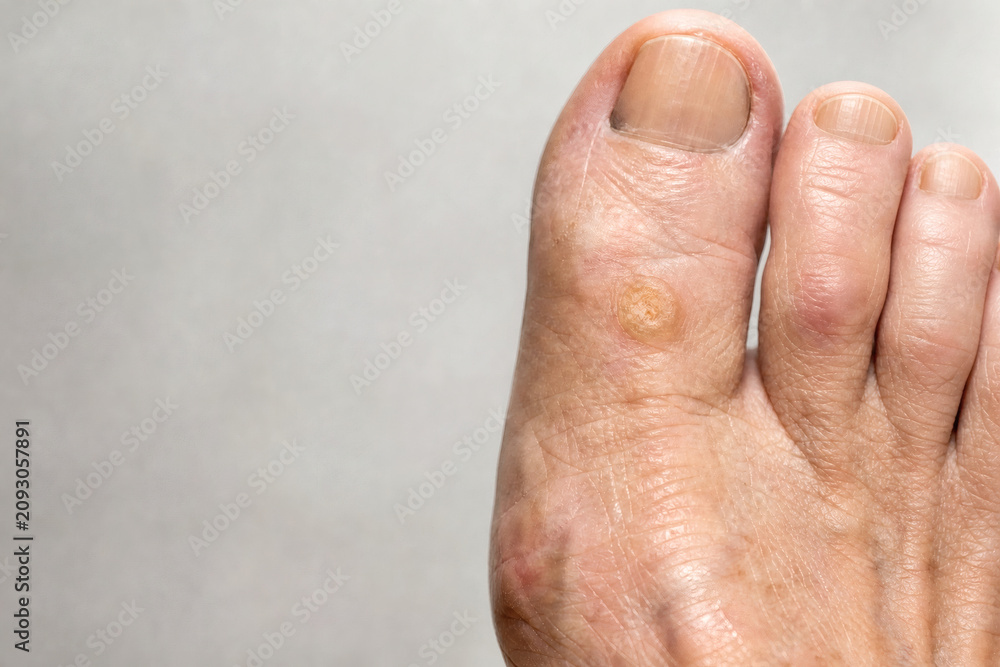 Fototapeta premium Corn on Great Toe of Senior Patient Close Up