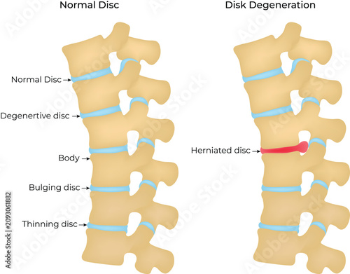 Konstfotografi Spinal Disc Degeneration and Herniation Medical Illustration