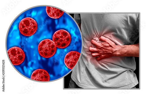 Cyclosporiasis disease as a foodborne parasitic illness caused by Cyclospora cayetanensis as an outbreak with contaminated food or water resulting in explosive diarrhea and digestive illness.