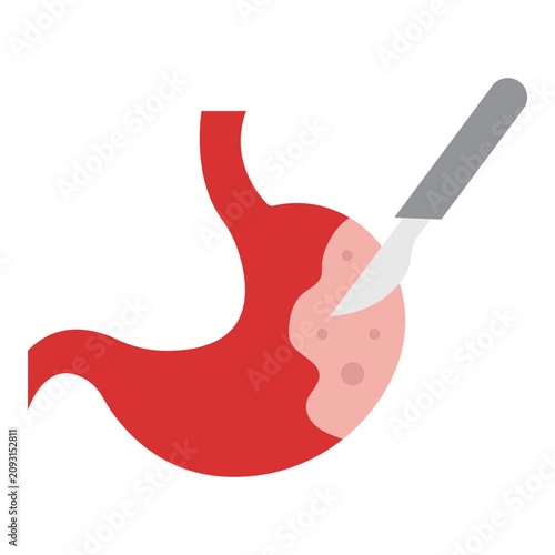 Tableau sur toile Stomach Cancer Surgery with Scalpel Procedure