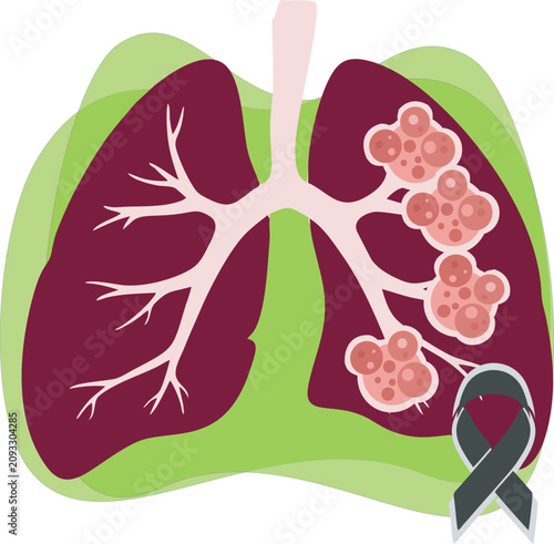 Foto World Lung Cancer Day aims to commemorate, celebrate, and support those affected by lung cancer