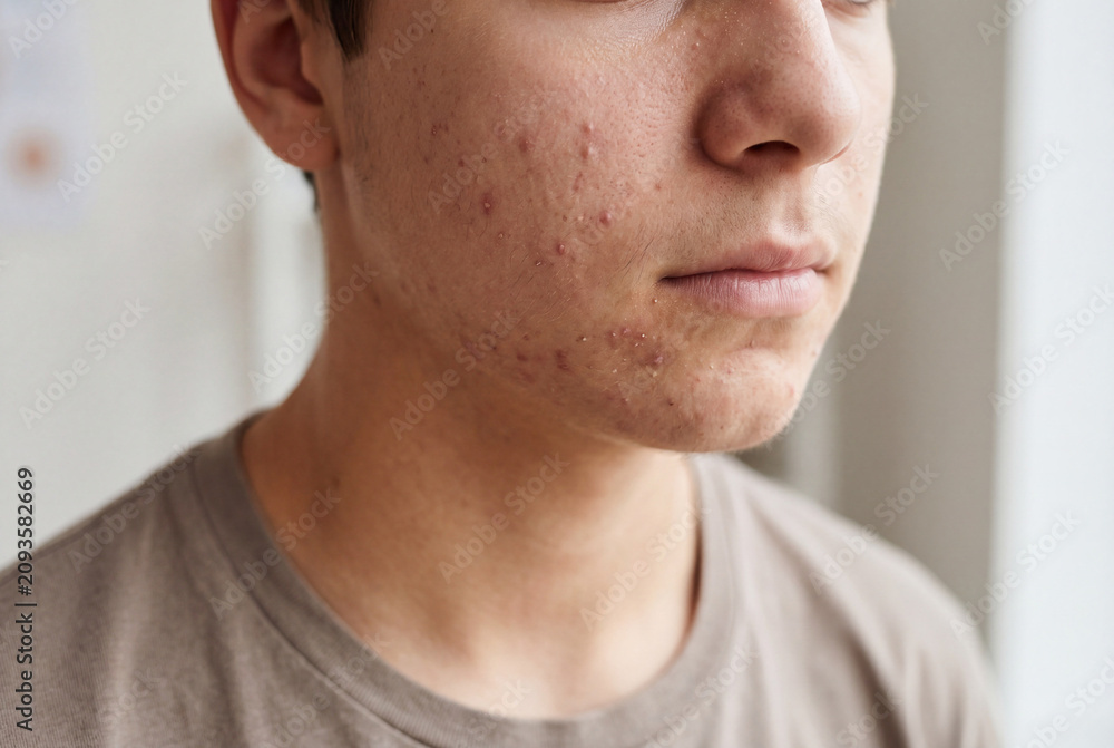 Fototapeta premium Young person's face showing acne and skin problems