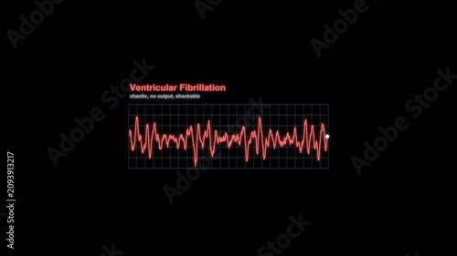 Ventricular Fibrillation ECG Rhythm Animation Labeled Heart Monitor Alpha 4K
