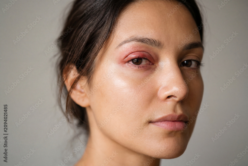 Naklejka premium Close up of young woman face with swollen red eyelid and eye infection