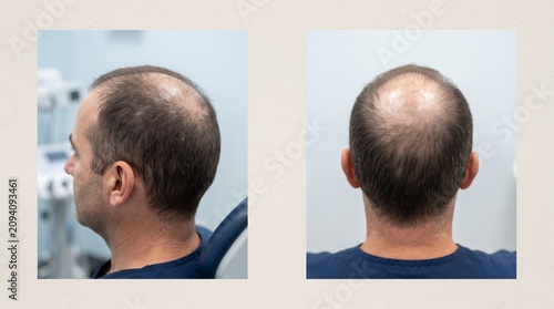 Two views of a man's head showing hair loss and thinning scalp. The left image shows a side profile, and the right image shows the back of his head.