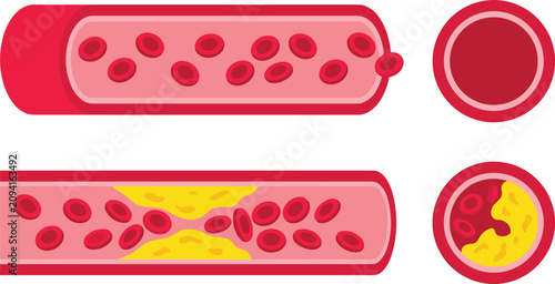 Artery cross section clipart collection featuring healthy and blocked blood vessels with cholesterol plaque medical vector illustration set