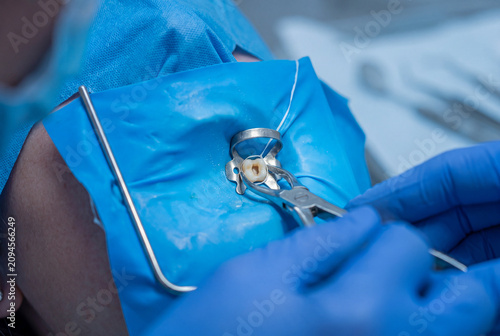 Close up view of a patient mouth with a blue rubber dam isolator and metal clamp during a precise root canal endodontic surgery procedure in a dental clinic.