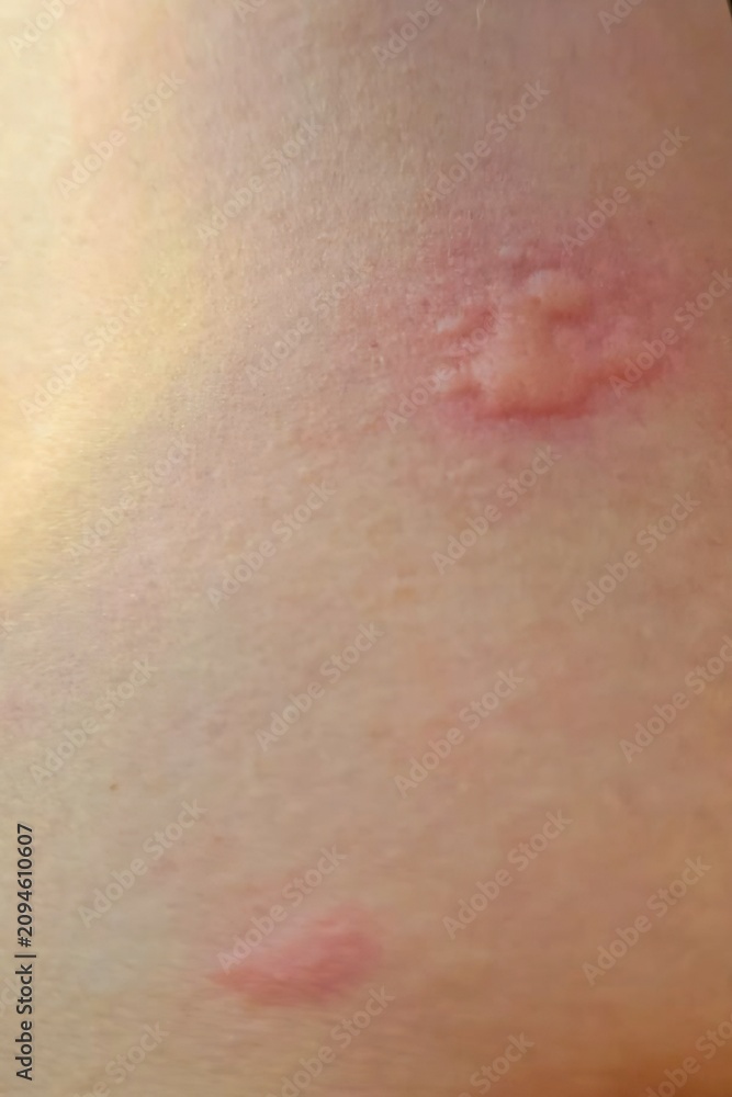 Fototapeta premium Close up of a severe skin rash and hives on a person's stomach due to an acute allergic reaction
