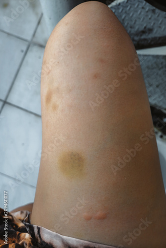 Dermatological condition showing inflamed skin with prominent hives and swelling
