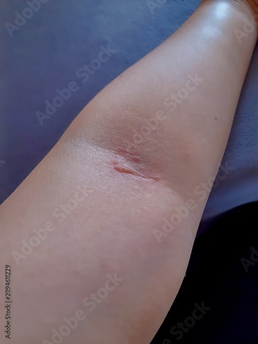 Skin texture showing a severe case of hives, swelling, and redness from an environmental or chemical allergy